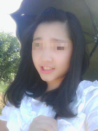 牙黄牙齿贴面全过程,哪里可以贴面修复黄牙