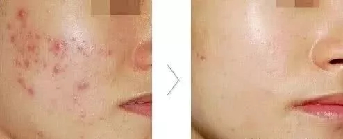 脸上痘痘严重做什么医美项目,脸上痘痘该做什么医美