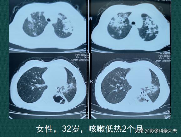 瀹濆鍙戠儳38.5鍙互涓嶅悆鑽悧,32宀佺硸灏跨梾瀹濆