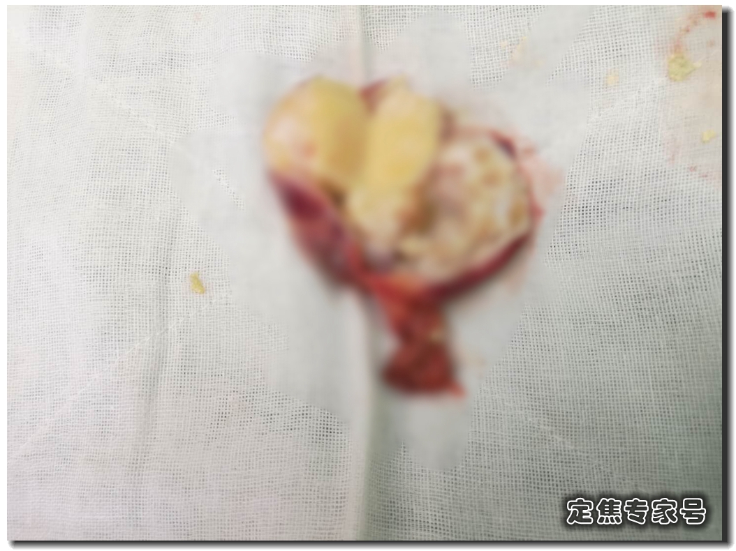 胸口疼发现了一个肿瘤严重吗,胸口疼去检查发现有一个瘤子