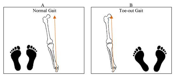 跑步时脚是外八字怎么纠正,膝盖内扣脚外八字跑步