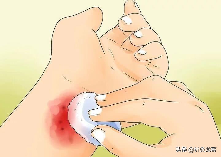 针灸出现淤青怎么办?会影响疗效吗?