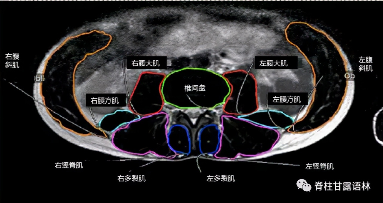 腰椎间盘突出中央型和旁侧型,腰椎间盘与椎板间隙的对应关系