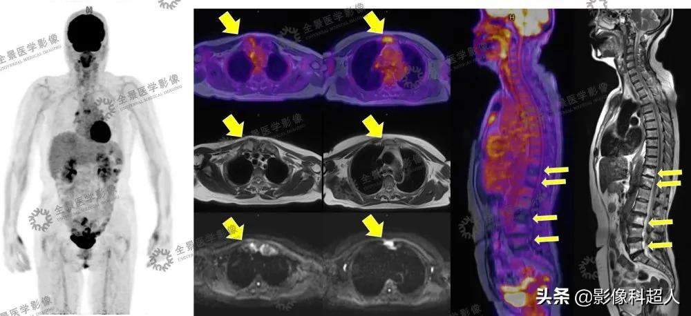一些极其罕见的疾病,有哪些极其罕见的病
