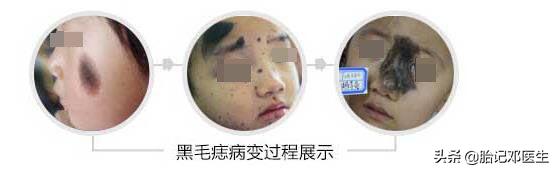 面容杀手,常见胎记的类型