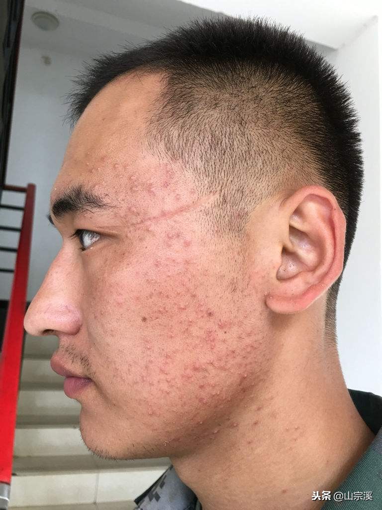 20+男生值得收藏的祛痘手册，关于痘痘，你不要只会用洗面奶洗