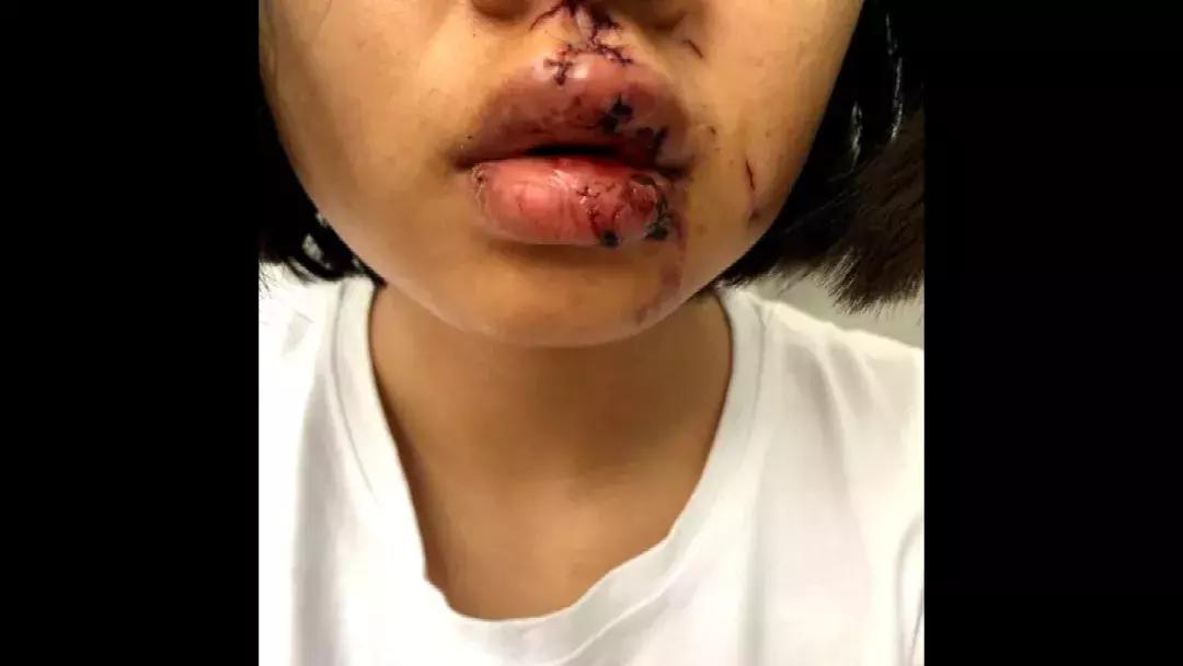 女子被狗咬脸毁容赔偿,女子被狗咬脸毁容律师