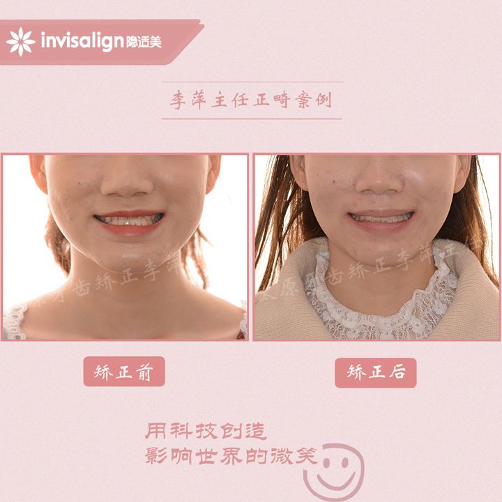 太原矫正牙齿需要做正颌吗,太原牙齿二次矫正