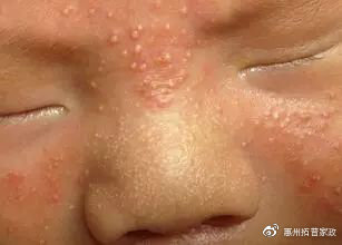 婴儿尿布湿疹的最快自愈方法,婴儿湿疹痤疮尿布疹