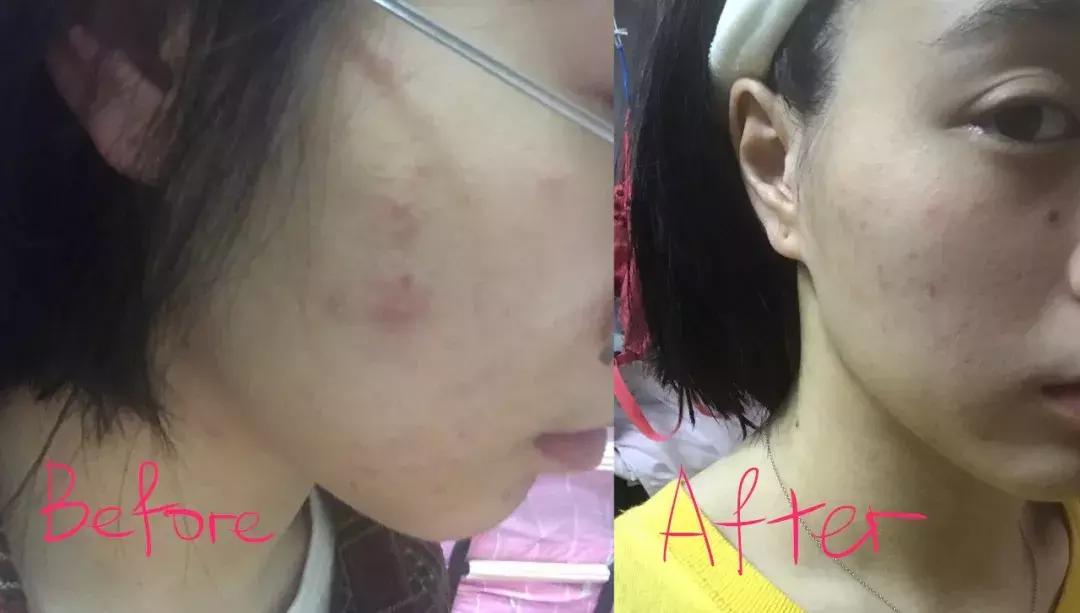 鎷晳鐥樼棙鐨勯粦绉戞妧,鎷晳鐥樿倢鐑傝劯