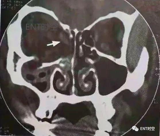 医学影像学解剖鼻骨,医学影像骨折