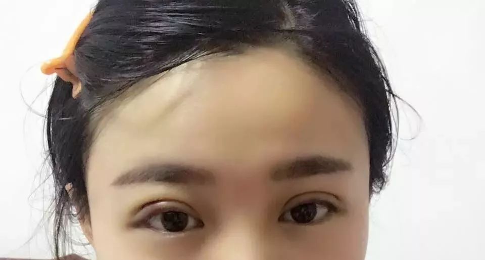 双眼皮术后肿胀不对称是失败了吗,双眼皮术后严重不对称怎么办