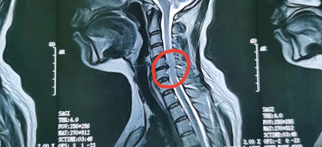 因为颈椎病，她连饺子都包不成