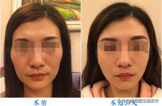 面部小拉皮手术提升效果和视频,面部提升手术和拉皮手术是一样吗