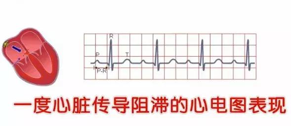 心律不齐是否可以治愈,心律不齐有多大问题能治愈吗