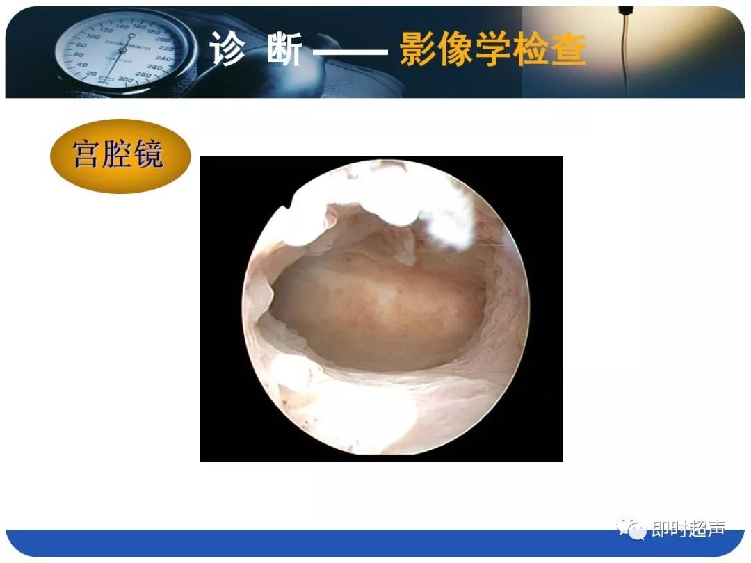 孕妇剖宫产瘢痕憩室,剖宫产瘢痕憩室息肉