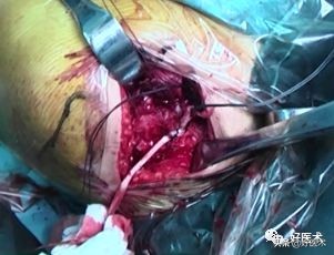 肩锁关节脱位手术后多久可以喝酒,肩锁关节脱位钢板内固定步骤记录