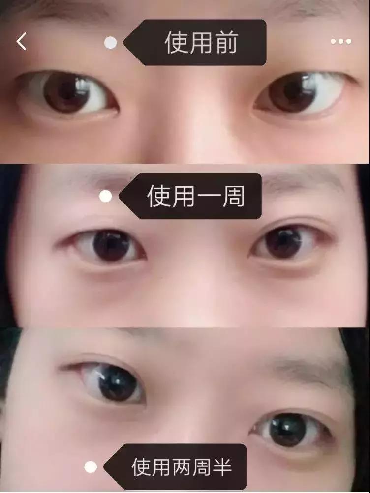 改善眼袋仅980元不开刀让你更出众,消除眼袋细纹大概多少钱