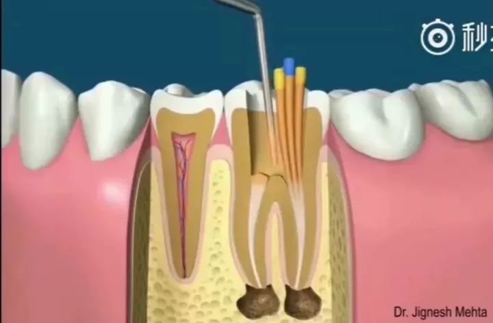 有蛀牙但没时间做根管怎么办,蛀牙多严重做根管