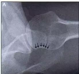 几种严重骨折医学名称,常见的骨折有哪些名称