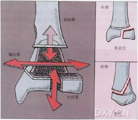 所有骨折都叫什么名字,骨折的名称有哪些