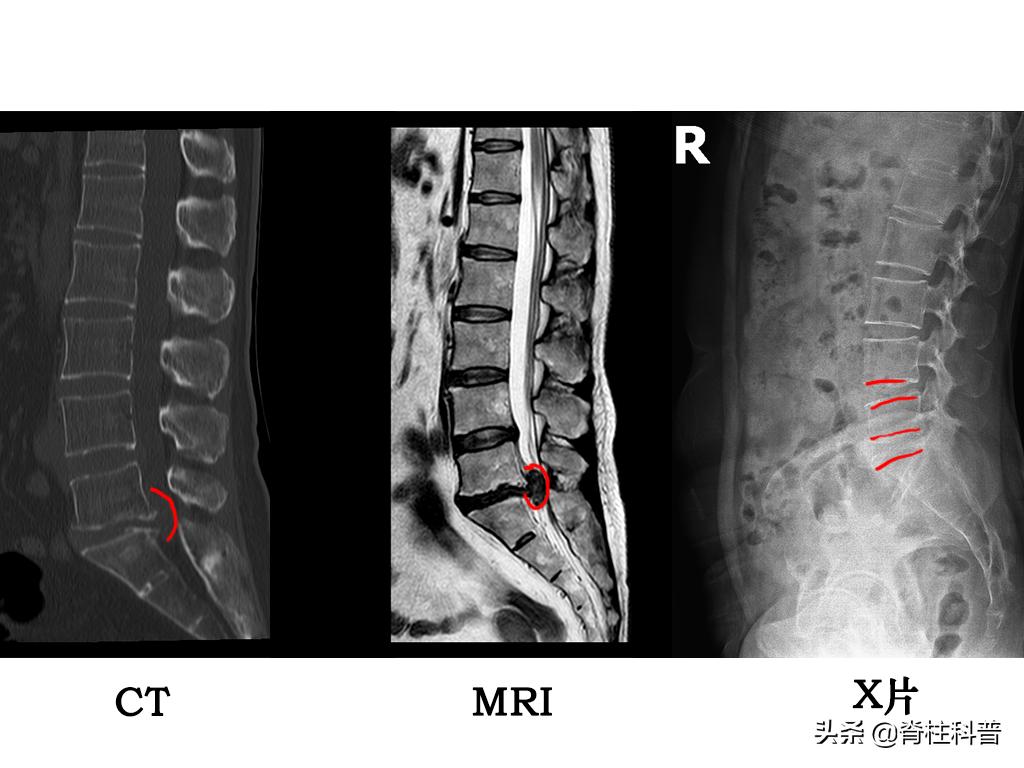 腰椎间盘突出拍x光还是做磁共振,腰椎间盘突出要做核磁还是ct