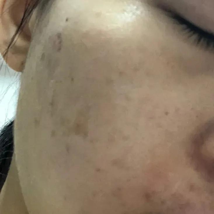 辟谣、吃酱油加深痘印?芦荟胶治好痘坑?别傻了!