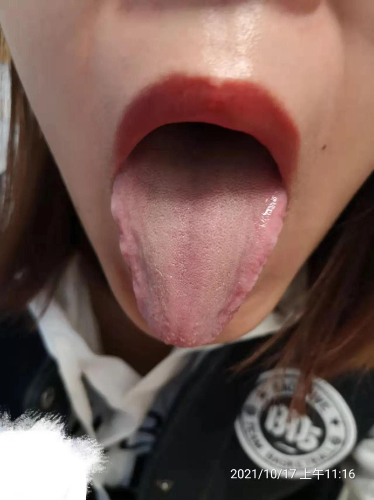 中药治疗多囊卵巢综合征案例,专治多囊卵巢闭经中成药