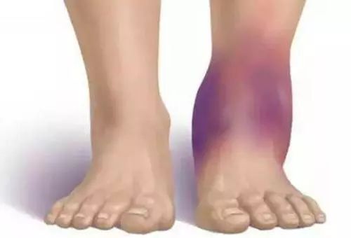 崴脚可能隐藏巨大风险吗,崴脚告别习惯性崴脚