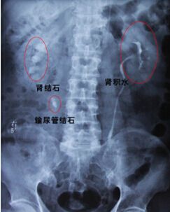 泌尿系结石尿结石,肾结石输尿管结石膀胱结石的症状