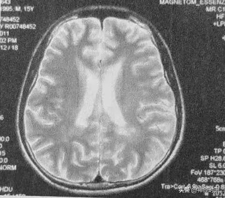 中医治疗多发性硬化的成功病例,今日病例