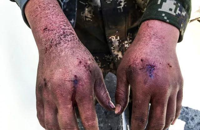 液氮引起事故,液氮冻伤为啥叫烫伤