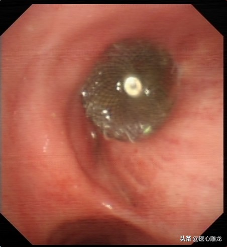 肺癌术后出现支气管胸膜瘘原因,肺癌患者做完气管镜老是咳血