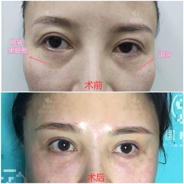 凹陷脸怎么整形,面部凹陷显老怎么整