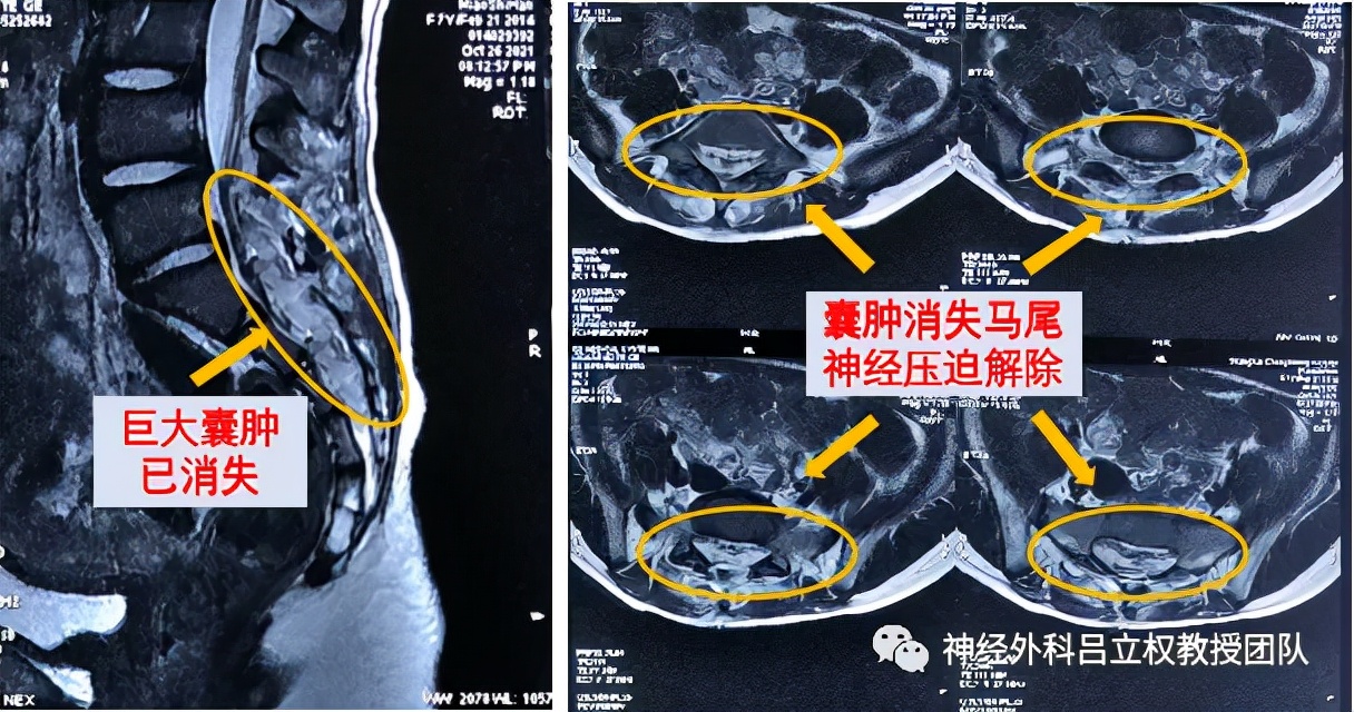 骶管囊肿的非手术治疗,骶管囊肿手术失败有什么后果