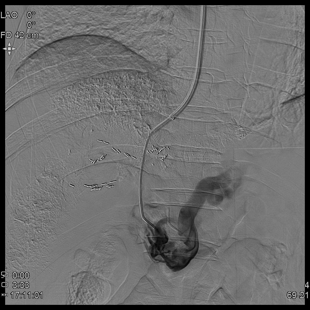 肝癌门静脉癌栓能做介入手术吗,肝癌门静脉癌栓中医治疗