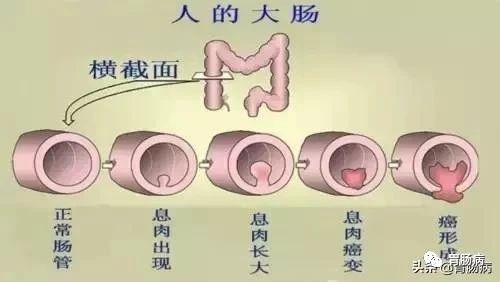 腺瘤性肠息肉切除后会癌变吗,肠息肉管状腺瘤癌变几率高吗