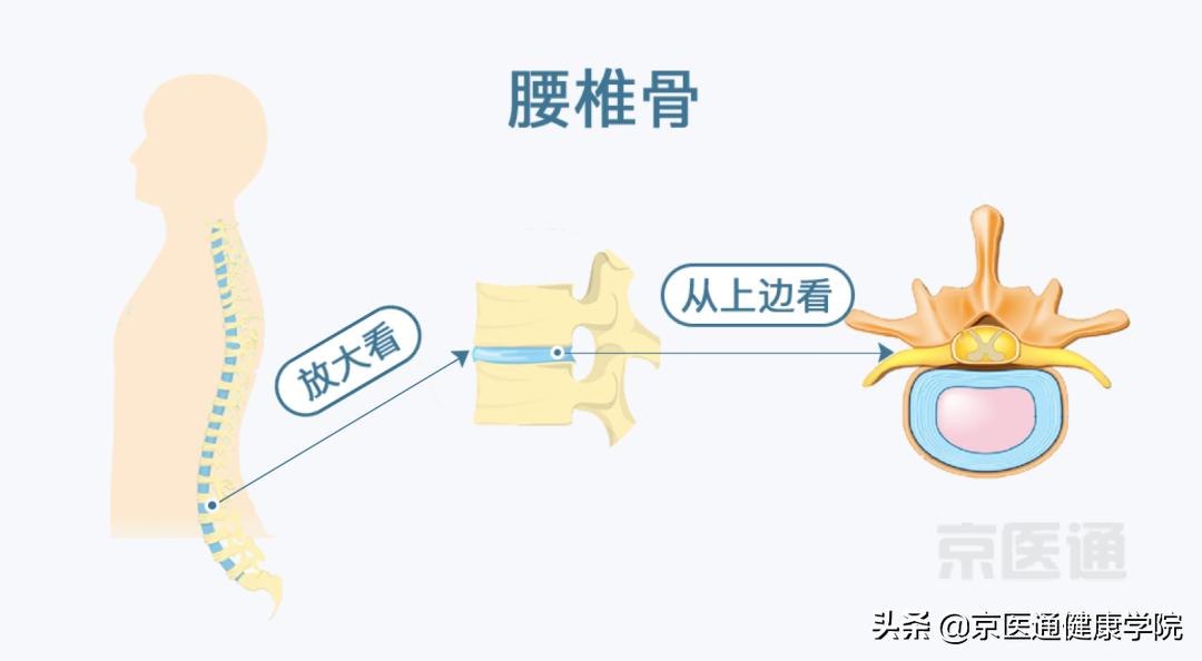 腰痛、腿痛是什么病？骨科医生用一块「羊蝎子」告诉你