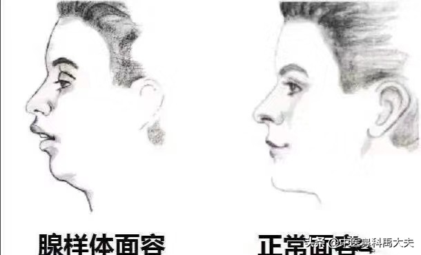 腺样体肥大是什么样子的,怎样是腺样体肥大面容