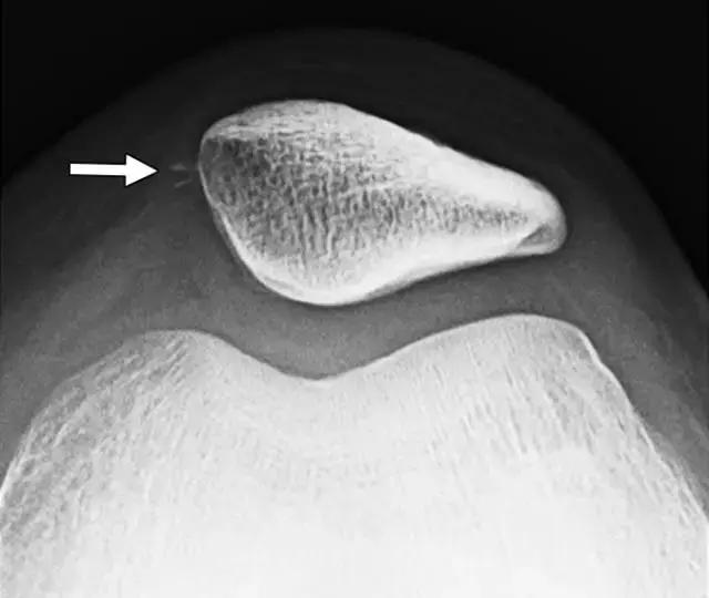 骨折处出现麻痹感,骨折跟精神状态有关