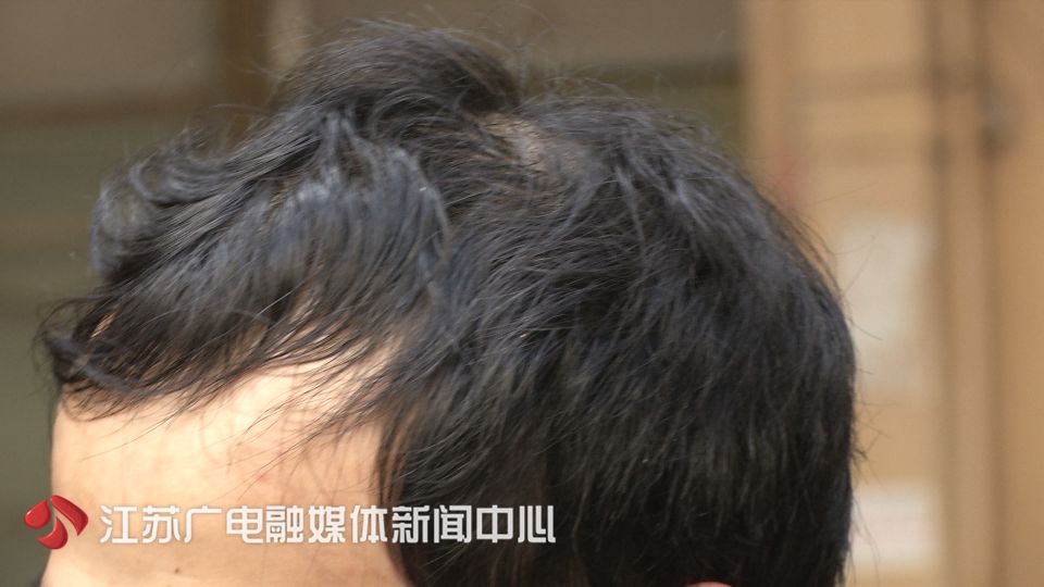 一个疗程2980，做完不掉发！小伙掏钱试了试，头更秃了！