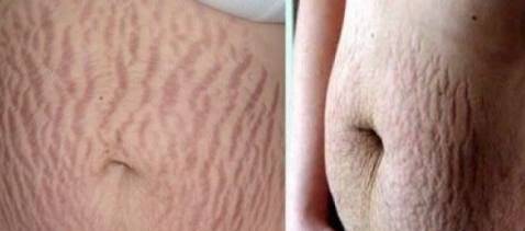 产后妊娠纹怎么去除,产后祛除妊娠纹最有效的方法