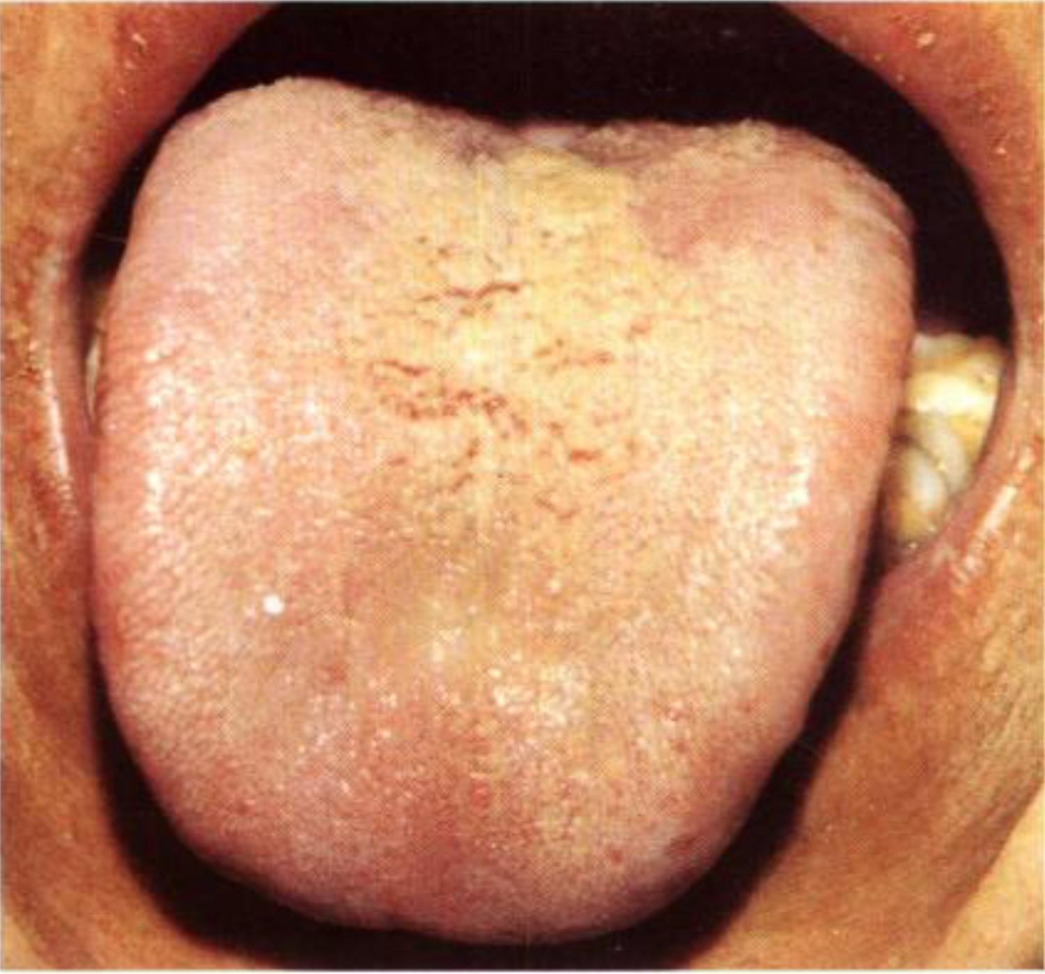 如何从舌苔判断健康,怎样通过舌苔颜色判断身体状况