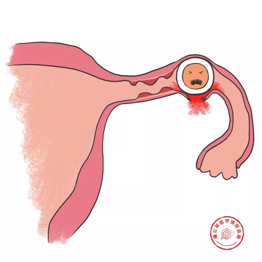 宫外孕是不是等到爆发才知道,宫外孕有啥感觉都没有的吗