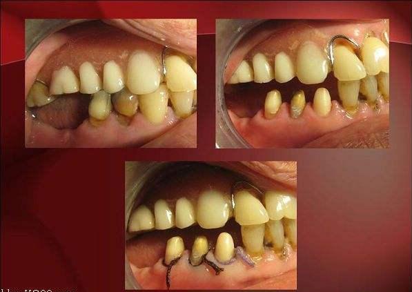 刷牙感觉牙齿松动怎么回事,由于刷牙太猛导致牙齿损伤怎么办