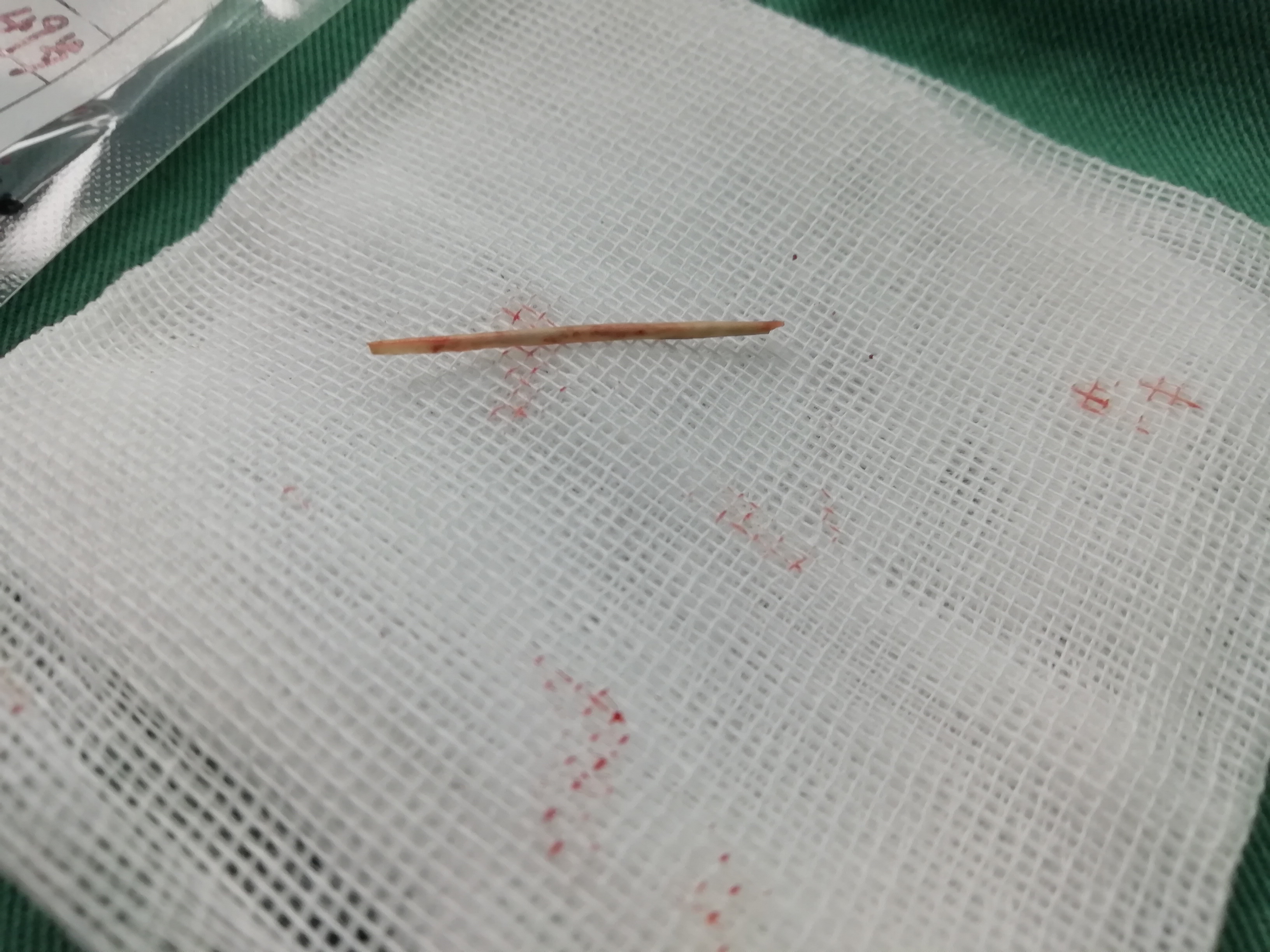 屁屁痛是什么原因,屁屁痛是上火吗