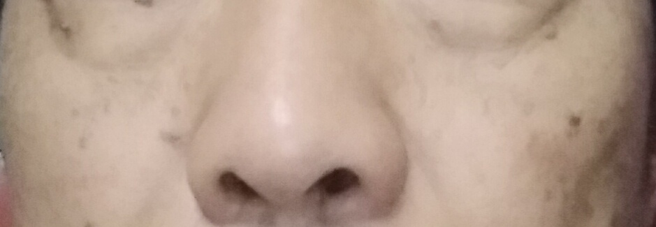 40多岁脸上起黑斑是怎么回事,油溅到脸上有黑斑多久消失图片