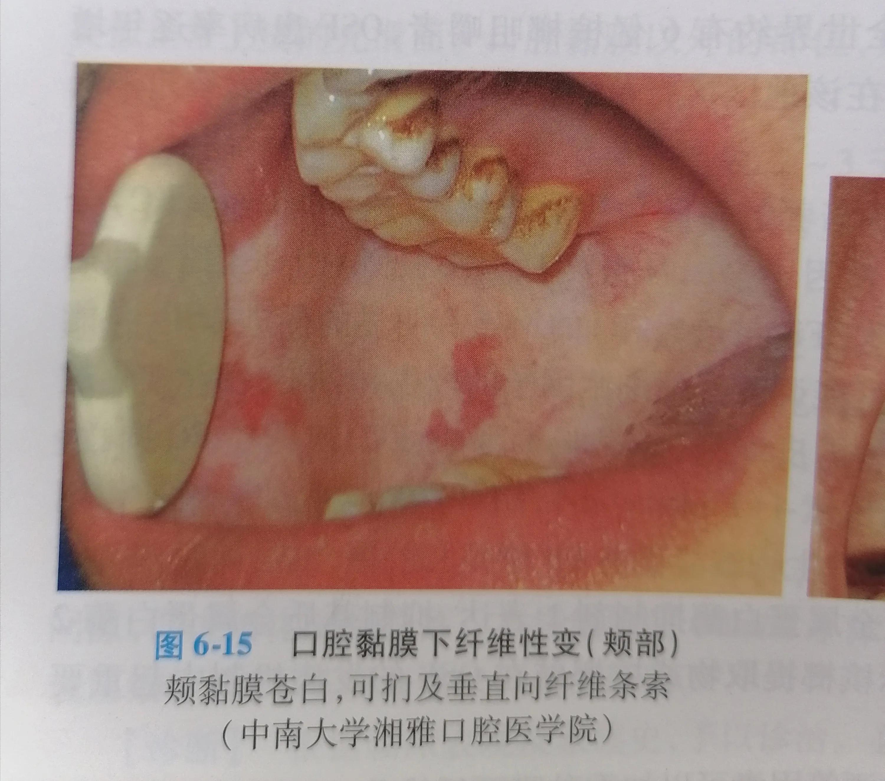 还在嚼槟榔吗,你嚼过槟榔吗