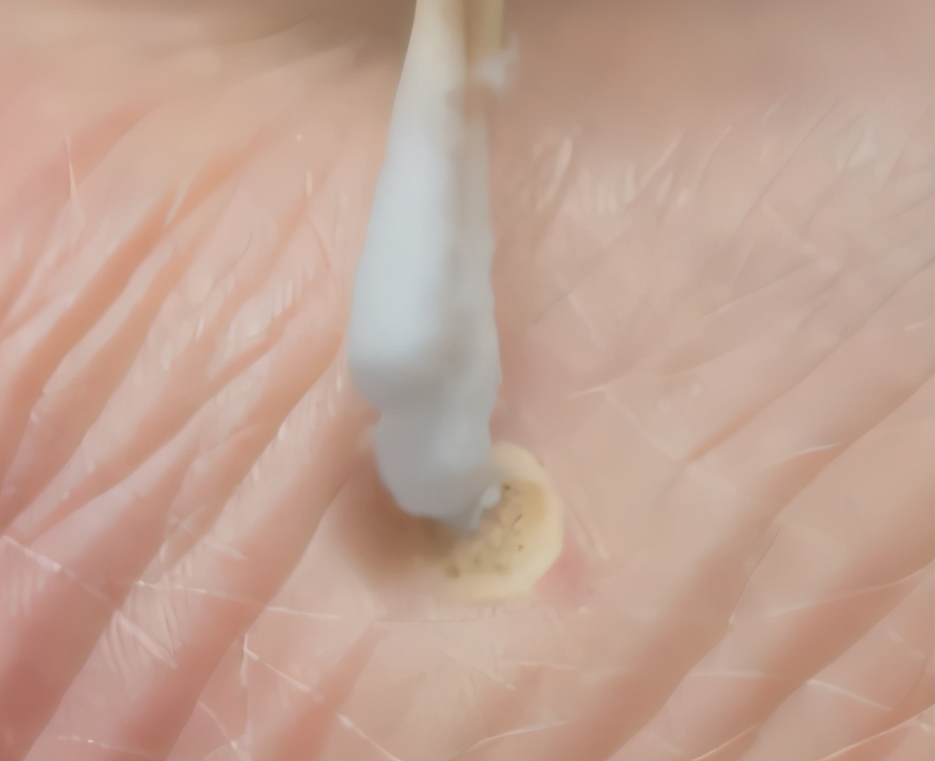 液氮冷冻怎么去除增厚的皮肤,液氮冷冻手指表皮变薄