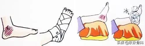 踝关节受伤过可进行哪些锻炼,踝关节受伤后怎么锻炼